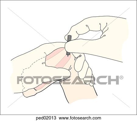 Illustration showing heel puncture in safe area. View Large Illustration Drawing - Illustration showing heel puncture in safe area.. Fotosearch