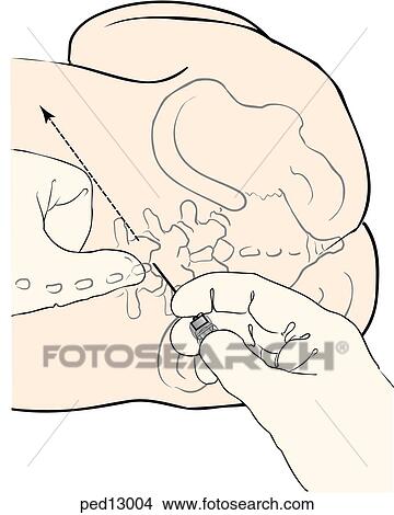 Illustration showing pelvic region of child in the lateral recumbant position; spinal needle placement is demonstrated using a one-handed approach; good alignment of needle is facilitated by placing the tip of the thumb of noninserting hand on the spinou View Large Illustration Stock Illustration - Illustration showing pelvic region of child in the lateral recumbant position; spinal needle placement is demonstrated using a one-handed approach; good alignment of needle is facilitated by placing the tip of the thumb of noninserting hand on the spinou. Fotosearch