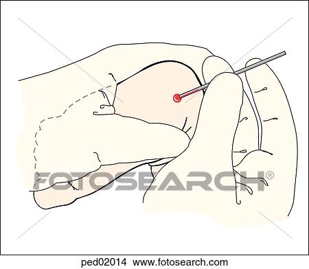 Illustration showing positioning of glass capillary tube for collection of specimen following heel puncture in safe area. View Large Illustration Stock Illustration - Illustration showing positioning of glass capillary tube for collection of specimen following heel puncture in safe area.. Fotosearch
