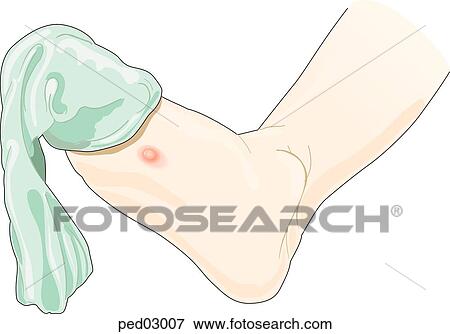 Stock Illustration - Illustration shows bottom of child's foot; sock is partially removed, remains over toes; blister is shown on ball of foot.. Fotosearch
