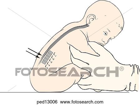 Illustration shows proper patient positioning for lumbar puncture to an infant; infant is held in sitting position with an arm and a leg in each of the assistant's hands; at the same time, head of infant is supported by the assistant's index finger; first View Large Illustration Stock Illustration - Illustration shows proper patient positioning for lumbar puncture to an infant; infant is held in sitting position with an arm and a leg in each of the assistant's hands; at the same time, head of infant is supported by the assistant's index finger; first. Fotosearch