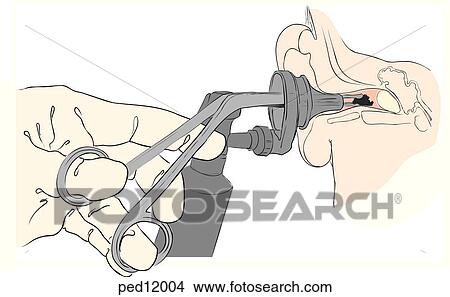 Illustration shows removal of a foreign body (cerumen) from the auditory canal of a child under direct visualization with an alligator forceps and an operating head otoscope. View Large Illustration Stock Illustration - Illustration shows removal of a foreign body (cerumen) from the auditory canal of a child under direct visualization with an alligator forceps and an operating head otoscope.. Fotosearch