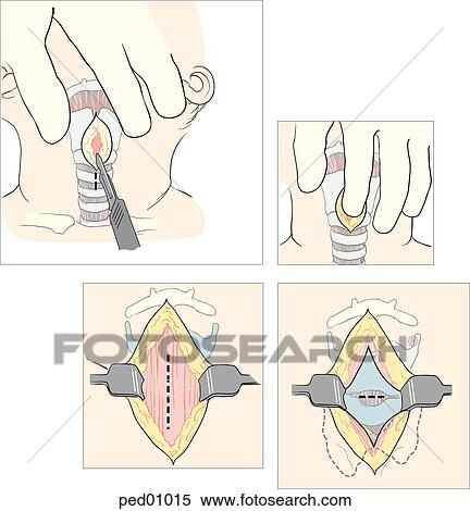 Illustrations showing initial, subcutanous and membranous incisions (dashed lines) for a surgical cricothyrotomy; (left) initial vertical incision; (middle) skin retraction, exposure of sternohyoid m.; (upper right) cricothyroid membrane palpation; View Large Illustration Stock Illustration - Illustrations showing initial, subcutanous and membranous incisions (dashed lines) for a surgical cricothyrotomy; (left) initial vertical incision; (middle) skin retraction, exposure of sternohyoid m.; (upper right) cricothyroid membrane palpation; . Fotosearch