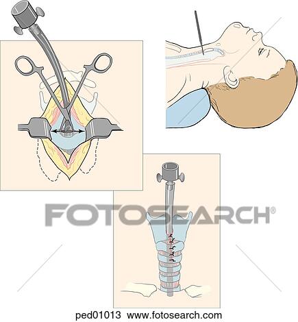 Illustrations showing (left) scalpel in position to perform horizontal incision through cricothyroid membrane; (middle) hemostats maintaining opening for insertion of tracheal tube, and (right) tracheal tube secured in place. View Large Illustration Drawing - Illustrations showing (left) scalpel in position to perform horizontal incision through cricothyroid membrane; (middle) hemostats maintaining opening for insertion of tracheal tube, and (right) tracheal tube secured in place.. Fotosearch