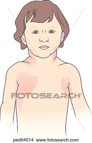 Image showing child suffering from typical signs of scarlet fever including a reddish rash on chest areas and swollen lymph nodes; fever also accompanies this disease. View Large Illustration Stock Illustration - Image showing child suffering from typical signs of scarlet fever including a reddish rash on chest areas and swollen lymph nodes; fever also accompanies this disease.. Fotosearch
