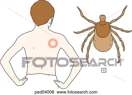 Stock Illustration - Image showing child with spreading annular- shaped lesion typical of Lyme disease; insert shows tick whose bite can result in this disease; structure in box shows actual size of tick.. Fotosearch