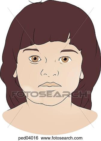 Image showing child with swollen glands in the neck and mandibular regions. View Large Illustration Stock Illustration - Image showing child with swollen glands in the neck and mandibular regions.. Fotosearch