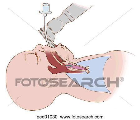 Image showing infant being intubated; laryngoscope is in place, intubation tube being placed into trachea. View Large Illustration Clipart - Image showing infant being intubated; laryngoscope is in place, intubation tube being placed into trachea.. Fotosearch