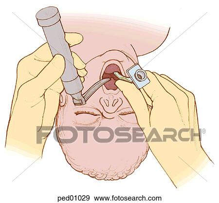 Stock Illustration - Image showing infant being intubated; laryngoscope being removed after placement of intubation tube.. Fotosearch