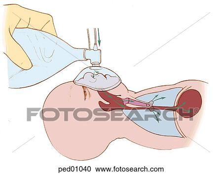 Image showing infant being resuscitated using a mask and Ambu bag; note how oxygen enters not only lungs but stomach as well. View Large Illustration Clipart - Image showing infant being resuscitated using a mask and Ambu bag; note how oxygen enters not only lungs but stomach as well.. Fotosearch