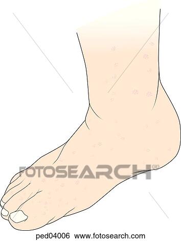 Stock Illustration - Image showing typical eruptions on the foot associated with hand-foot-and-mouth disease.. Fotosearch