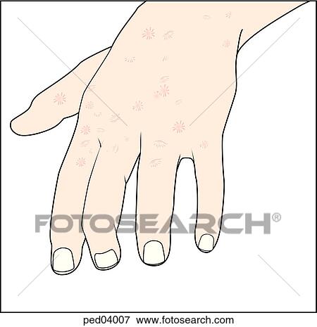 Image showing typical eruptions on the hand associated with hand-foot-and-mouth disease. View Large Illustration Stock Illustration - Image showing typical eruptions on the hand associated with hand-foot-and-mouth disease.. Fotosearch
