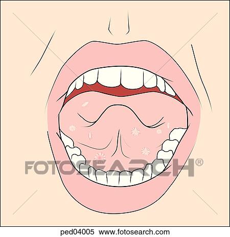 Stock Illustration - Image showing typical ulcers of the oral region associated with hand-foot-and-mouth disease.. Fotosearch