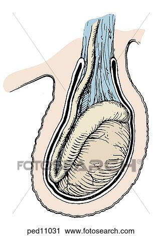 Image shows a bell-clapper deformity in the tunica vaginalis which can permit torsion of spermatic vessels seen in right image. View Large Illustration Clip Art - Image shows a bell-clapper deformity in the tunica vaginalis which can permit torsion of spermatic vessels seen in right image.. Fotosearch