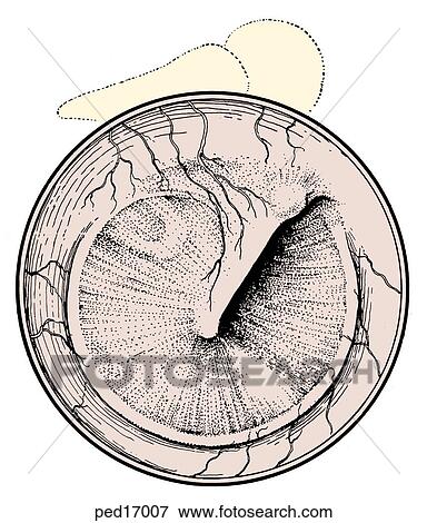 Stock Illustration - Image shows an otoscopic view of the normal right tympanic membrane and middle ear structures during an evaluation.. Fotosearch