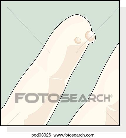 Stock Illustration - Image shows close up of wart.. Fotosearch