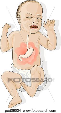 Infant suffering from colic with pain radiating from stomach. View Large Illustration Stock Illustration - Infant suffering from colic with pain radiating from stomach.. Fotosearch