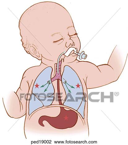 Drawing -  infant with an endotracheal tube in place in trachea. An improperly placed ET tube may result in oxygen in the stomach.. Fotosearch