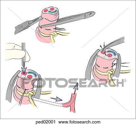 Introduction of umbilical artery catheter; (top) umbilical stump cut transversely above purse-string suture at base of cord; (middle) two hemostats evert edges and curved iris forceps gently dilate arterial lumen; (bottom) catheter inserted into umbilic View Large Illustration Clip Art - Introduction of umbilical artery catheter; (top) umbilical stump cut transversely above purse-string suture at base of cord; (middle) two hemostats evert edges and curved iris forceps gently dilate arterial lumen; (bottom) catheter inserted into umbilic. Fotosearch