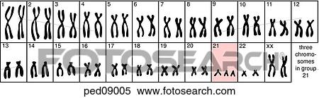 Stock Illustration - Karyotype of a person with Down syndrome; note the extra chromosome in group 21.. Fotosearch