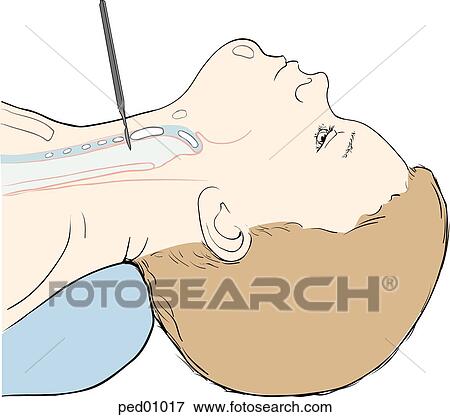 Lateral view of child's head and neck showing scalpel in correct position to perform horizontal incision through cricothyroid membrane. View Large Illustration Stock Illustration - Lateral view of child's head and neck showing scalpel in correct position to perform horizontal incision through cricothyroid membrane.. Fotosearch