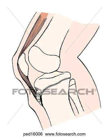 Stock Illustration - Lateral view of knee with Osgood-Schlatter disease; patellar tendon is attached to tibial tubercle apophysis in the immature child; at site of attachment healed microfractures are visible as enlarged area; note external bump at site.. Fotosearch
