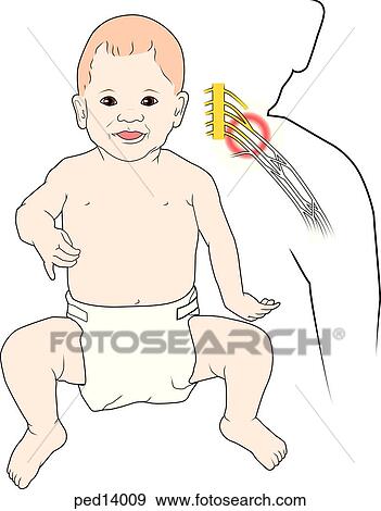 Stock Illustration - (Left) Boy with positional deformity of hand and arm (birth-Erb's palsy); (right) anatomy of brachial plexus region showing damage to the cervical nerve roots.. Fotosearch