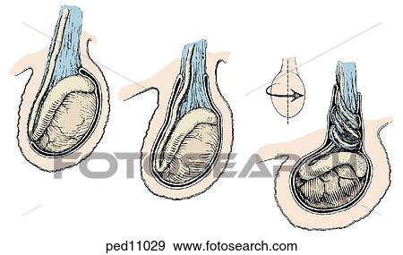 Left image shows normal testicular anatomy; (middle) a bell-clapper deformity in the tunica vaginalis which can permit torsion of spermatic vessels seen in right image. View Large Illustration Stock Illustration - Left image shows normal testicular anatomy; (middle) a bell-clapper deformity in the tunica vaginalis which can permit torsion of spermatic vessels seen in right image.. Fotosearch