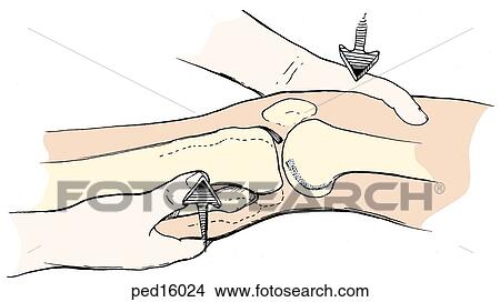 Stock Illustration - Leg undergoing Lachman's test.. Fotosearch