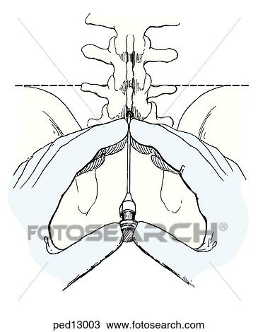 Lumbar puncture procedure; image shows one procedure for stabilizing and guiding the needle. View Large Illustration Drawing - Lumbar puncture procedure; image shows one procedure for stabilizing and guiding the needle.. Fotosearch