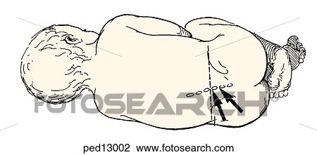 Drawing - Lumbar puncture procedure using the lateral decubitus position; image shows the desired sites between the posterior elements of L3 and L4 or L4 and L5.. Fotosearch