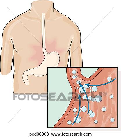 Stock Illustration - Main image on left shows location of pain at gastroesophageal junction; insert shows how gas and other stomach contents and reflux into esophagus resulting in heartburn-like pain.. Fotosearch