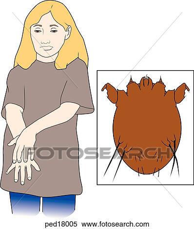 Main image shows girl scratching her hand; insert shows mite that causes itching, sarcoptes scabei. View Large Illustration Stock Illustration - Main image shows girl scratching her hand; insert shows mite that causes itching, sarcoptes scabei.. Fotosearch