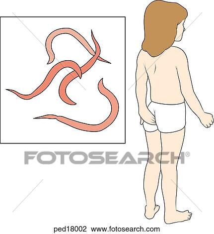 Main image shows young child scratch the anal region, an indication of pinworm (enterobius vermicularis) infestion; insert shows pinworms as seen under a microscope. View Large Illustration Drawing - Main image shows young child scratch the anal region, an indication of pinworm (enterobius vermicularis) infestion; insert shows pinworms as seen under a microscope.. Fotosearch
