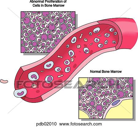 Clipart - Microscopic views of normal and abnormal bone marrow and sectioned blood vessel demonstrating blood cells flowing inside.. Fotosearch