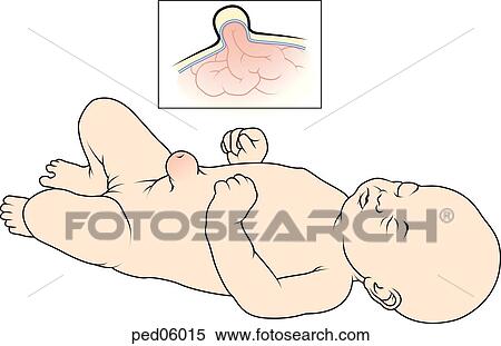 Neonate with visible umbilical hernia; Insert shows peritoneum pushing into umbilical area. View Large Illustration Stock Illustration - Neonate with visible umbilical hernia; Insert shows peritoneum pushing into umbilical area.. Fotosearch