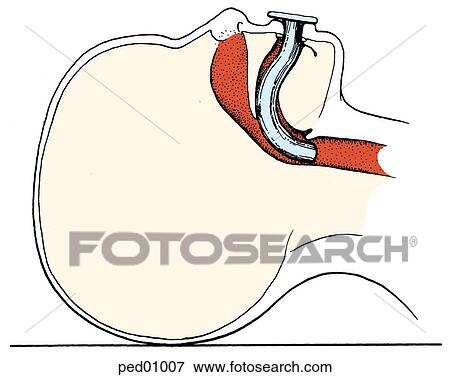 Stock Illustration - Oropharyngeal airway stenting mandibular block off pharyngeal wall; illustration shows oropharyngeal airway in place.. Fotosearch