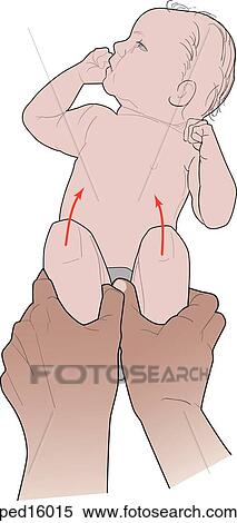 Ortolani test being performed on infant to test for a dilocated hip. View Large Illustration Stock Illustration - Ortolani test being performed on infant to test for a dilocated hip.. Fotosearch