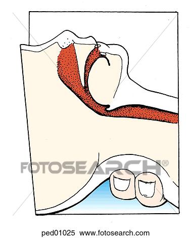 Partial relief of obstruction by head extension. View Large Illustration Stock Illustration - Partial relief of obstruction by head extension.. Fotosearch