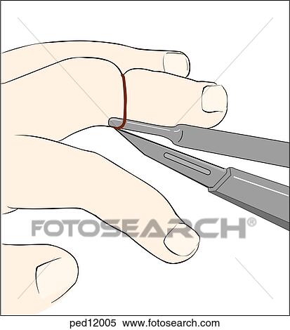 Stock Illustration of The removal of a hair tourniquet of the finger ...