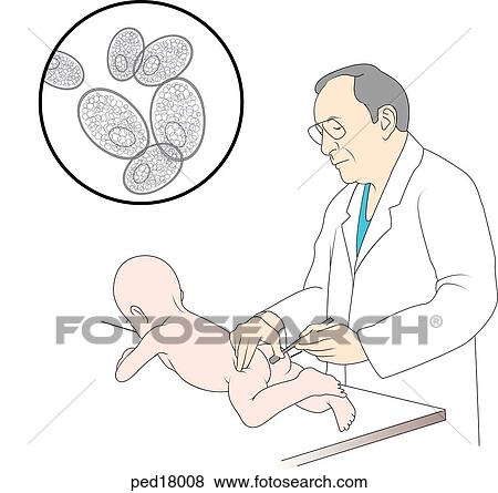 Picture of a doctor taking a sample from the rectal area of an infant to test for scabies. Insert shows eggs of mite as they would appear under a microscope. View Large Illustration Stock Illustration - Picture of a doctor taking a sample from the rectal area of an infant to test for scabies. Insert shows eggs of mite as they would appear under a microscope.. Fotosearch