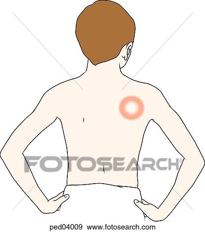 Posterior view of youth with clinical manifestation of Lyme disease: skin lesion of the type erythema migrans located on right shoulder. View Large Illustration Stock Illustration - Posterior view of youth with clinical manifestation of Lyme disease: skin lesion of the type erythema migrans located on right shoulder.. Fotosearch