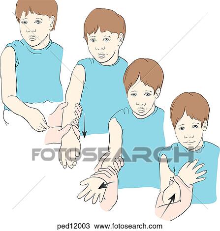 Drawing - Procedure for reduction of radial head subluxation (elbow dislocation) on a child, four steps are shown.. Fotosearch
