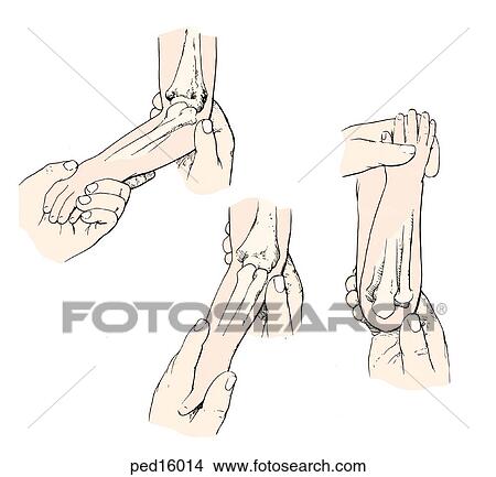 Radial head subluxation reduction; first, palm of child's hand is grasped as if to shake it; elbow is encircled with other hand, thumb over annular ligament; next, palm of child's hand is supinated and, third, in continuous motion elbow is flexed to s View Large Illustration Stock Illustration - Radial head subluxation reduction; first, palm of child's hand is grasped as if to shake it; elbow is encircled with other hand, thumb over annular ligament; next, palm of child's hand is supinated and, third, in continuous motion elbow is flexed to s. Fotosearch