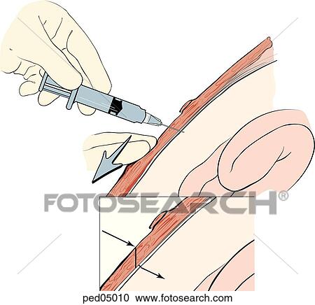 Sagittal view of abdominal wall showing needle insertion into peritoneum 2 cm. below the umbilicus at an oblique angle; at time of insertion caudal traction on overlying skin is applied. Insert: z-track formation after release of skin and removal of ne View Large Illustration Clipart - Sagittal view of abdominal wall showing needle insertion into peritoneum 2 cm. below the umbilicus at an oblique angle; at time of insertion caudal traction on overlying skin is applied. Insert: z-track formation after release of skin and removal of ne. Fotosearch