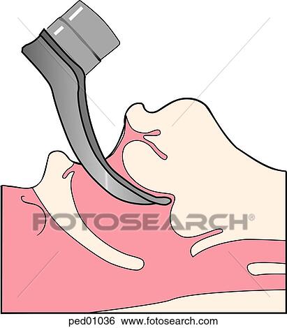Stock Illustration - Sagittal view of adolescent's head and neck showing direct laryngoscopy using a curved blade; blade in this case is too short, resulting in impingement on midportion of tongue, potentially obscuring landmarks.. Fotosearch