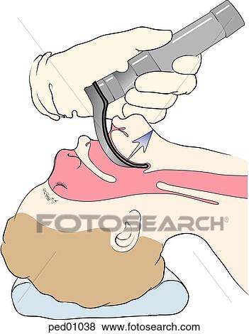 Sagittal view of adolescent's head and neck showing direct laryngoscopy using a curved blade; correct size of blade allows for correct positioning of blade in vallecula. View Large Illustration Stock Illustration - Sagittal view of adolescent's head and neck showing direct laryngoscopy using a curved blade; correct size of blade allows for correct positioning of blade in vallecula.. Fotosearch