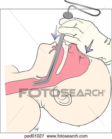 Stock Illustration - Sagittal view of child's head and neck showing insertion of endotracheal tube into trachea; laryngoscope has been removed.. Fotosearch