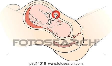 Stock Illustration - Sagittal view of infant passing through the birth canal with umbilical cord being visibly compressed by the uterus.. Fotosearch