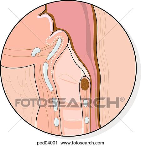 Sagittal view of pharyngeal area showing enlarged and inflamed epiglottis, signs of epiglottitis; dashed line shows normal size of structures. View Large Illustration Clip Art - Sagittal view of pharyngeal area showing enlarged and inflamed epiglottis, signs of epiglottitis; dashed line shows normal size of structures.. Fotosearch